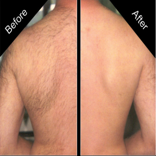 How to Get Rid Of Back Hair Permanently