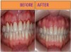 Bleeding Gums