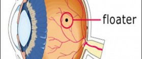 The Eye Floaters