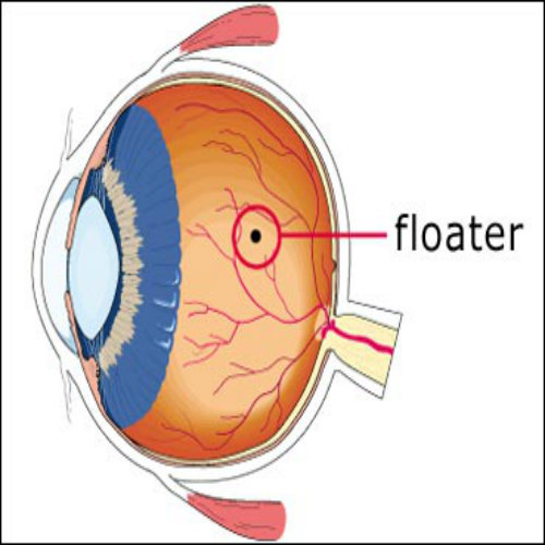 The Eye Floaters