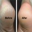 Guide about how to get rid of calluses on feet