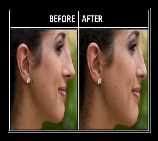 Get Smaller Nose without Surgery