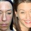 How To Conceal Melasma