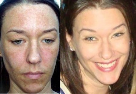 How To Conceal Melasma