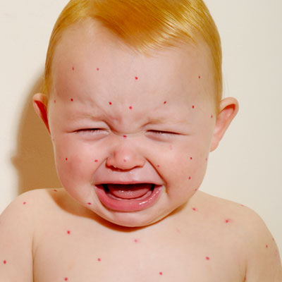 Bathing a child with chickenpox