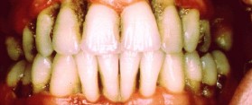 A gum disease