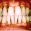 A gum disease