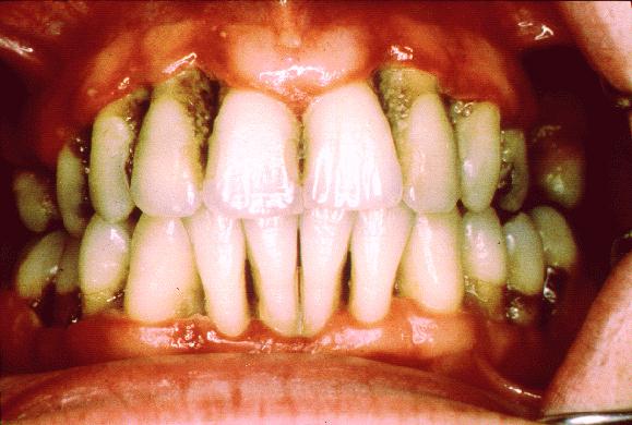 A gum disease