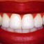 Get Rid of Yellow Stains on Teeth