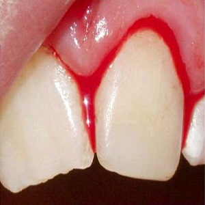 How to Stop Bleeding Gums After Deep Cleaning