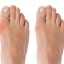 Bunions Treatment