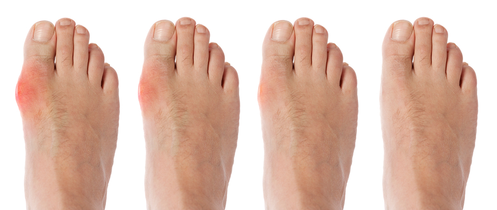 Bunions Treatment