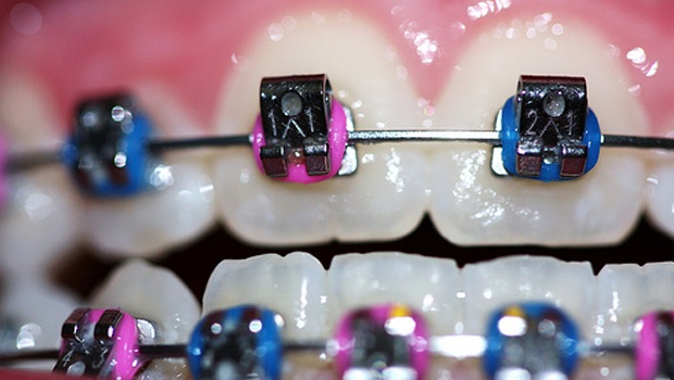 color of your braces