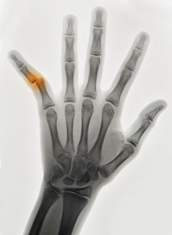 x-ray of a broken finger