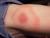 Lyme Disease Circular Rash