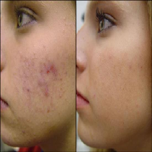 Natural Skin Treatments for Acne Scars