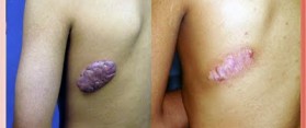 Keloids
