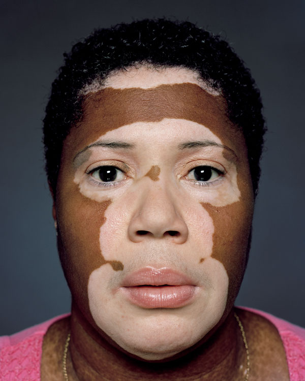 Vitiligo Patient