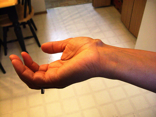 Getting Rid Of Ganglion Cyst