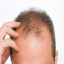 Prevent Male Pattern Baldness