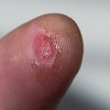 Abrasion caused by hammer blow