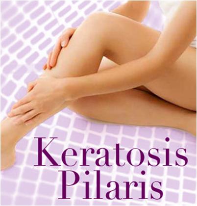 Keratosis Pilaris