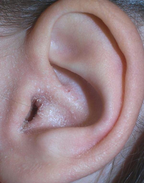 Blackheads in ear