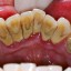 Remove Tartar from Teeth