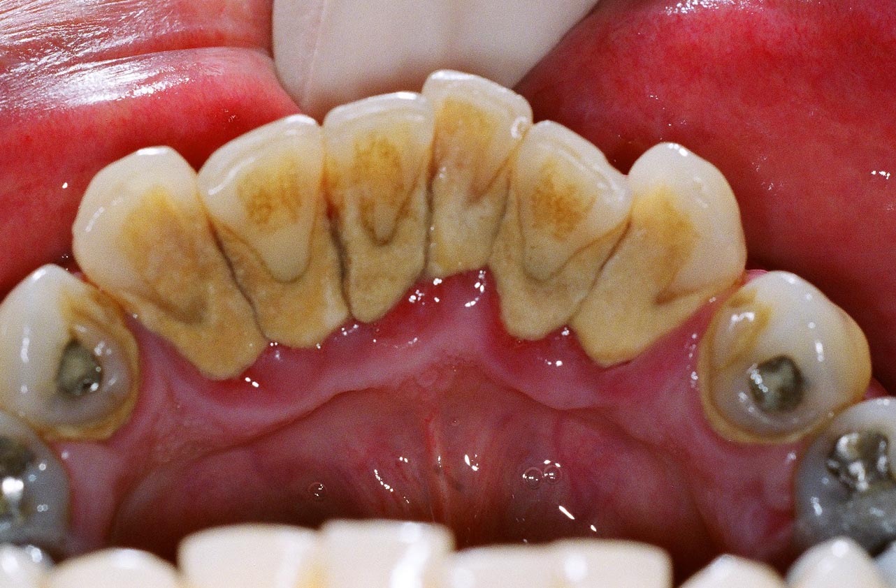 Remove Tartar from Teeth