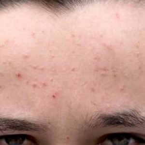 Whiteheads on Forehead