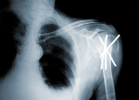 Clavicle Fracture