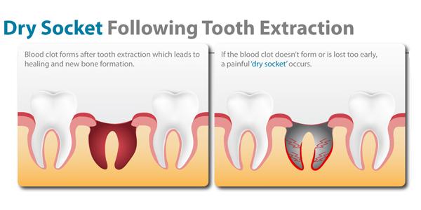 Dry socket after tooth extraction