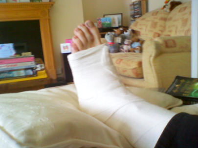 Treating a Foot Fracture at Home
