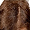 Remove Dandruff to Cure Thinning Hair