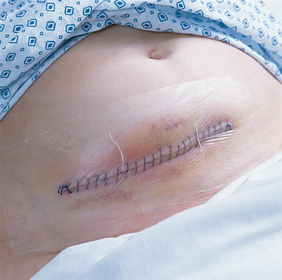 Surgical Wound