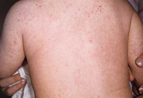 Atopic Dermatitis on a Child