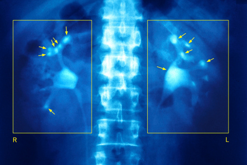 Pass Kidney Stones Pain Free