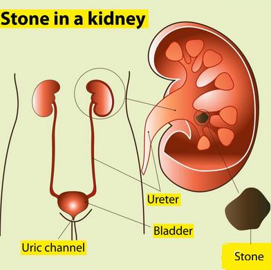 Pass a Kidney Stone without Surgery