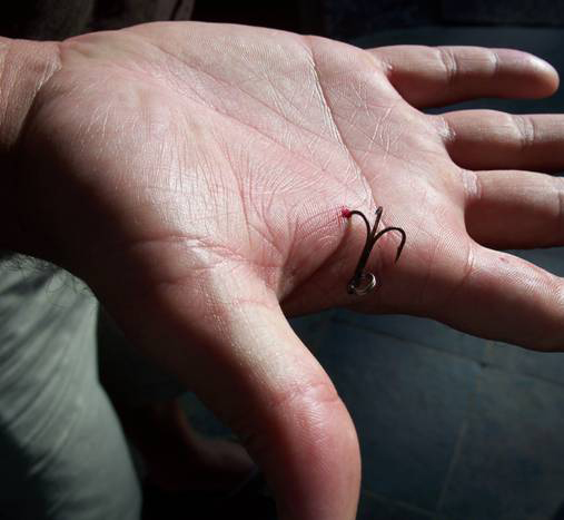 Fish Hook stuck in hand