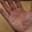 Remove a Wood Splinter from Skin