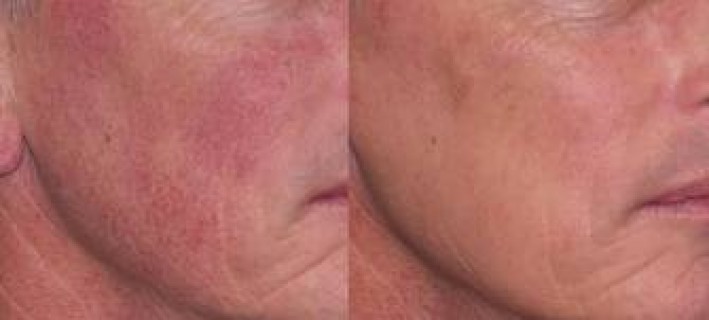 Broken Blood Vessels