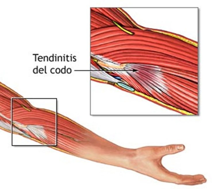 Treat Elbow Tendonitis