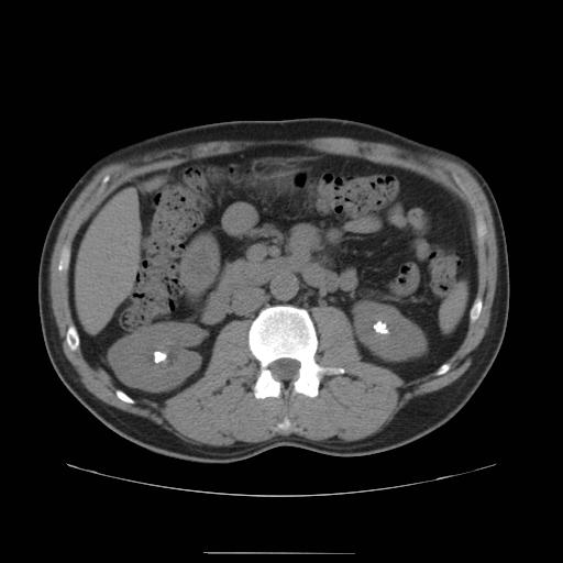 Urolithiasis