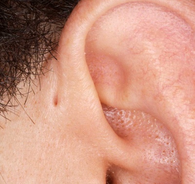 Tips about How to Treat a Benign Ear Cyst