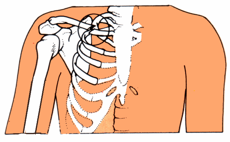 Tips about How to Treat a Broken Collarbone