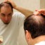 Use Biotin for Hair Loss