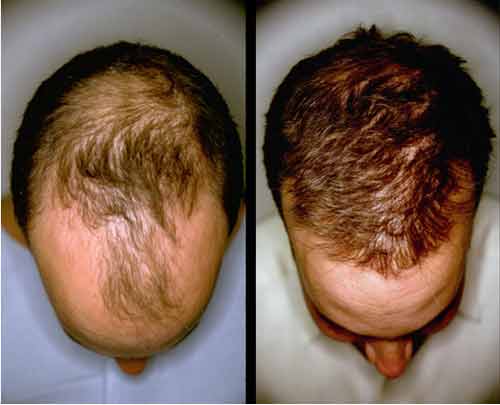 Vitamins to Spur Hair Growth