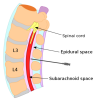 Epidural