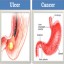 Ulcer and Cancer