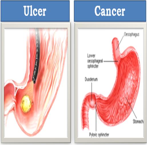 Ulcer and Cancer